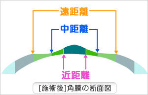 プレスビーマックス画像２