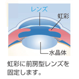 フェイキックＩＯＬ前房型