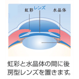 アイシーエル後房型